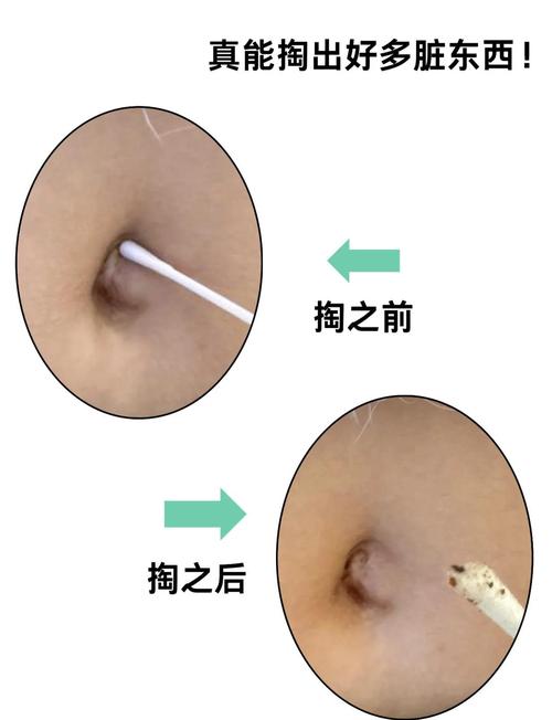 怀孕期间能不能扣肚脐眼-第3张图片-中州医学会