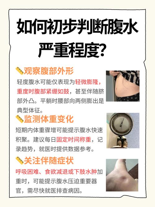 儿童腹水究竟是什么原因引起的?-第2张图片-中州医学会 儿童腹水究竟是什么原因引起的?-第2张图片-中州医学会