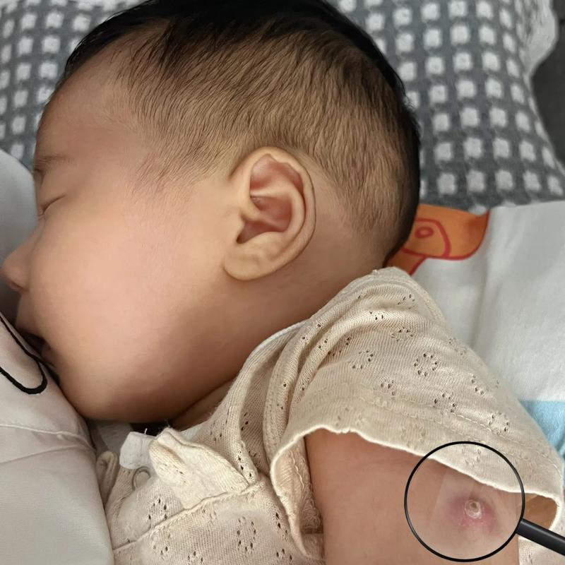 新生儿打卡介苗后出现脓包正常吗？-第3张图片-中州医学会