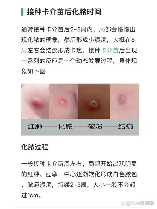 新生儿打卡介苗后出现脓包正常吗？-第2张图片-中州医学会