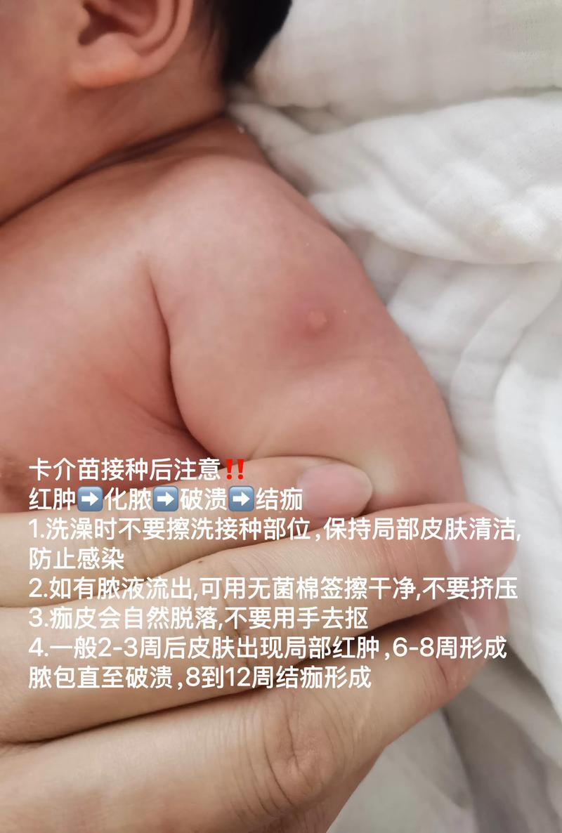 新生儿打卡介苗后出现脓包正常吗？-第1张图片-中州医学会