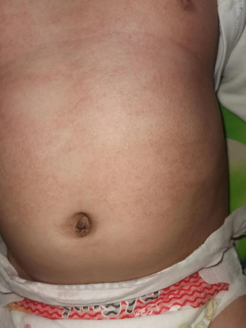 新生儿全身皮肤网状紫红色是何原因？-第2张图片-中州医学会