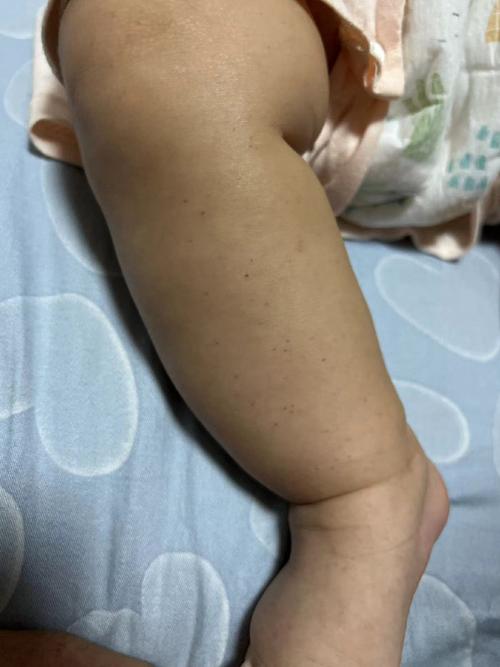 新生儿全身皮肤网状紫红色是何原因？-第1张图片-中州医学会