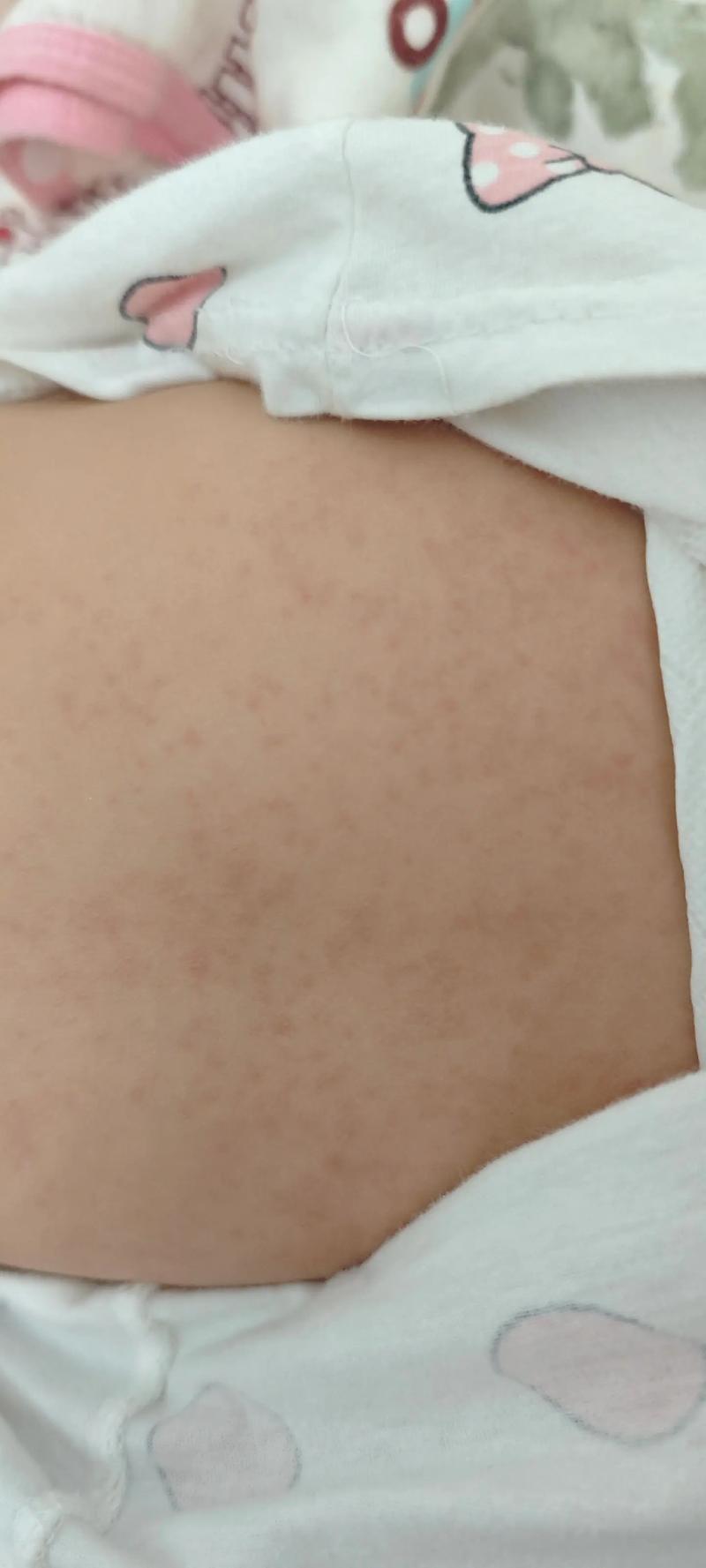 新生儿全身皮肤网状紫红色是何原因？-第3张图片-中州医学会