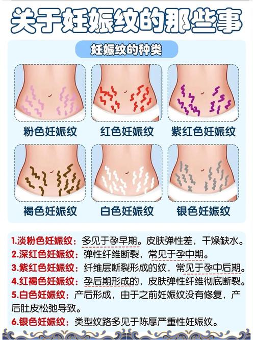 孕期长妊娠纹怎么办？-第1张图片-中州医学会
