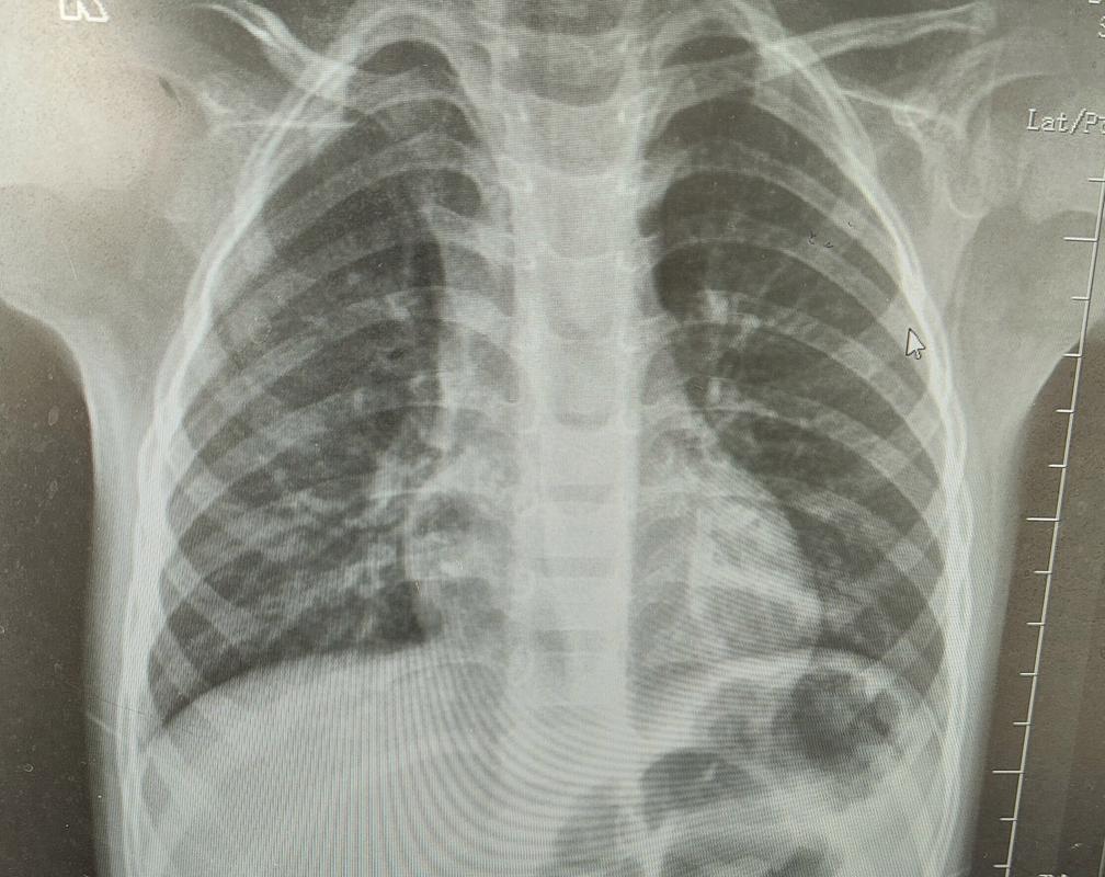 新生儿拍肺部CT影响有多大？-第1张图片-中州医学会