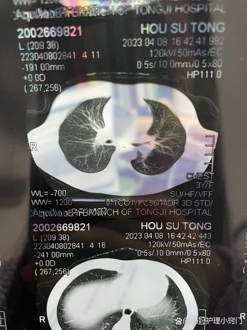 新生儿拍肺部CT影响有多大？-第3张图片-中州医学会