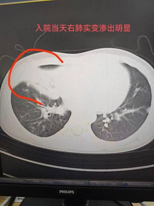 新生儿拍肺部CT影响有多大？-第2张图片-中州医学会