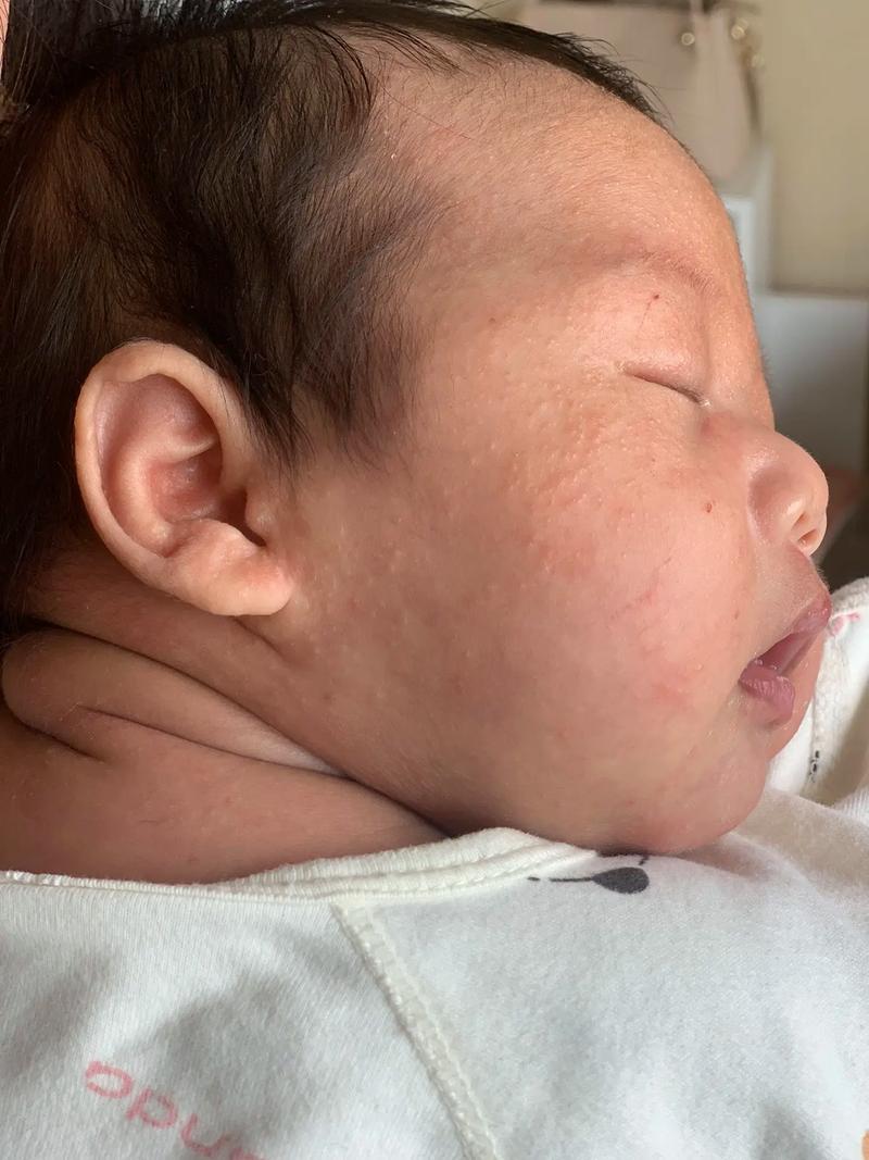 新生儿脸上起小疙瘩怎么回事-第1张图片-中州医学会