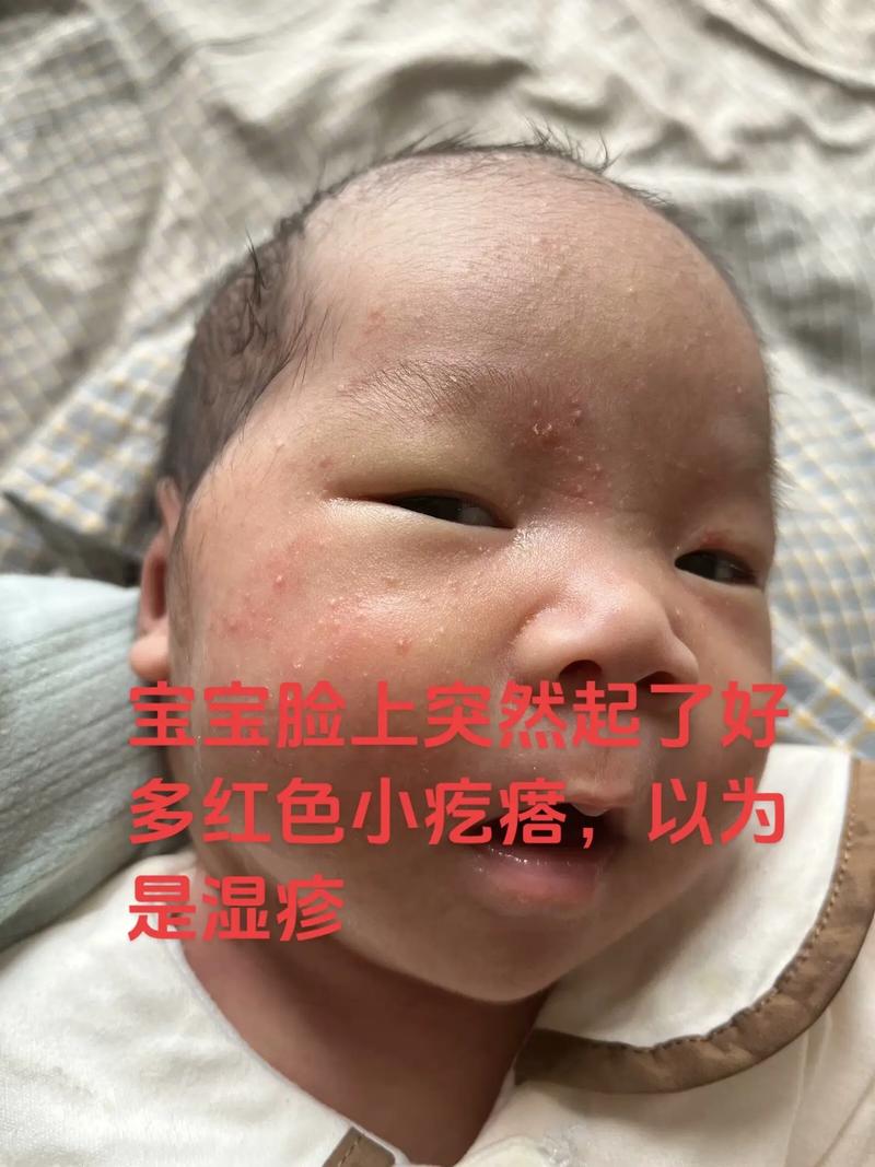 新生儿脸上起小疙瘩怎么回事-第2张图片-中州医学会
