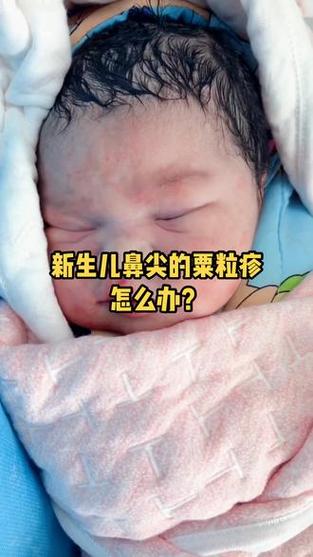 新生儿鼻尖上长小白点是什么-第2张图片-中州医学会