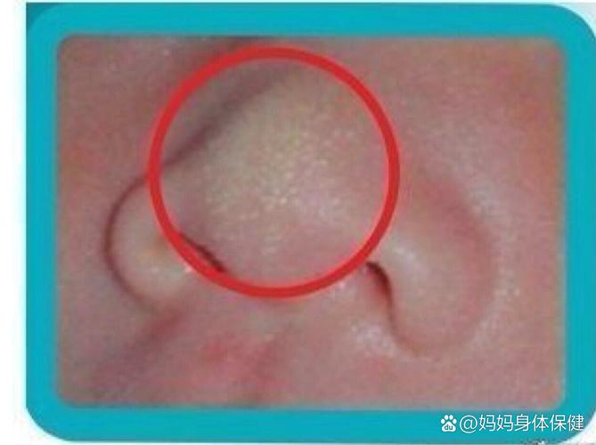 新生儿鼻尖上长小白点是什么-第1张图片-中州医学会