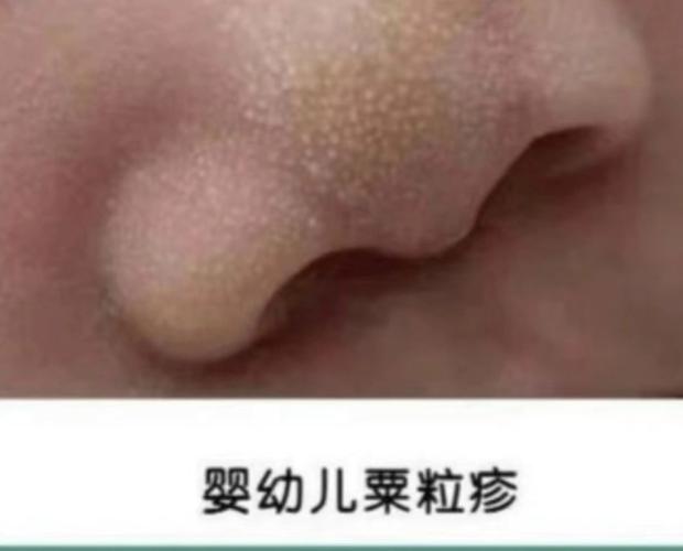 新生儿鼻尖上长小白点是什么-第3张图片-中州医学会