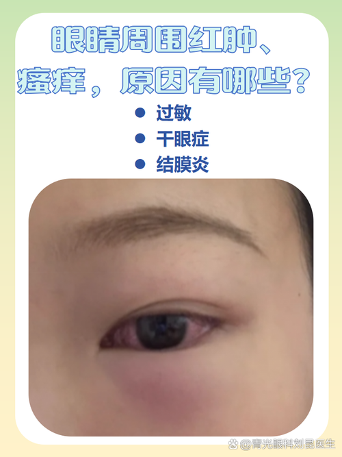 儿童眼睛周围红肿痒怎么办-第1张图片-中州医学会