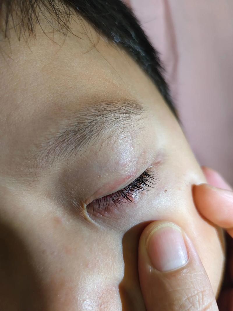 儿童眼睛周围红肿痒怎么办-第2张图片-中州医学会