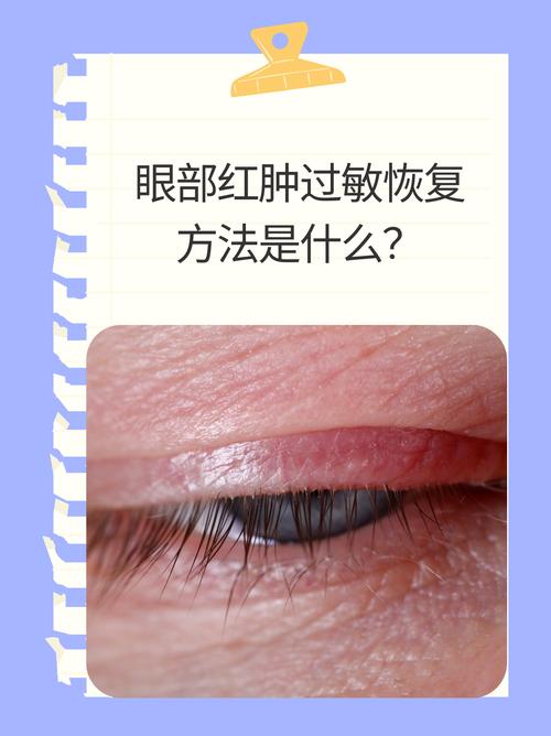 儿童眼睛周围红肿痒怎么办-第3张图片-中州医学会