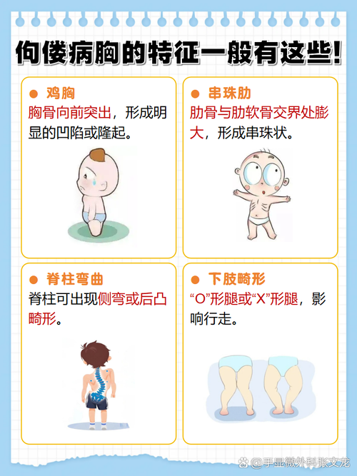 儿童佝偻病是缺啥造成的？-第1张图片-中州医学会