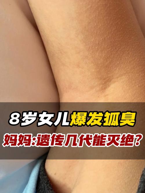 儿童有狐臭几岁可以看出来-第2张图片-中州医学会