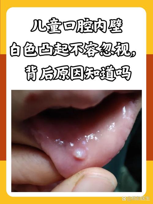 新生儿上颚小米粒白点是啥？-第3张图片-中州医学会