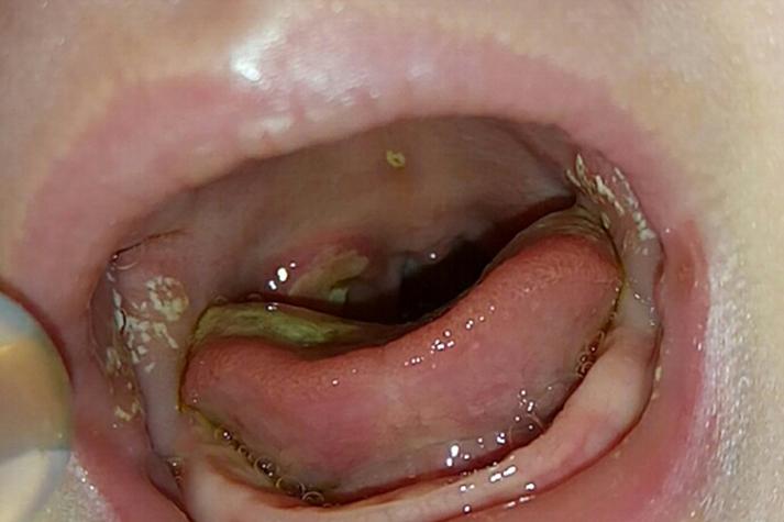 新生儿上颚小米粒白点是啥？-第1张图片-中州医学会