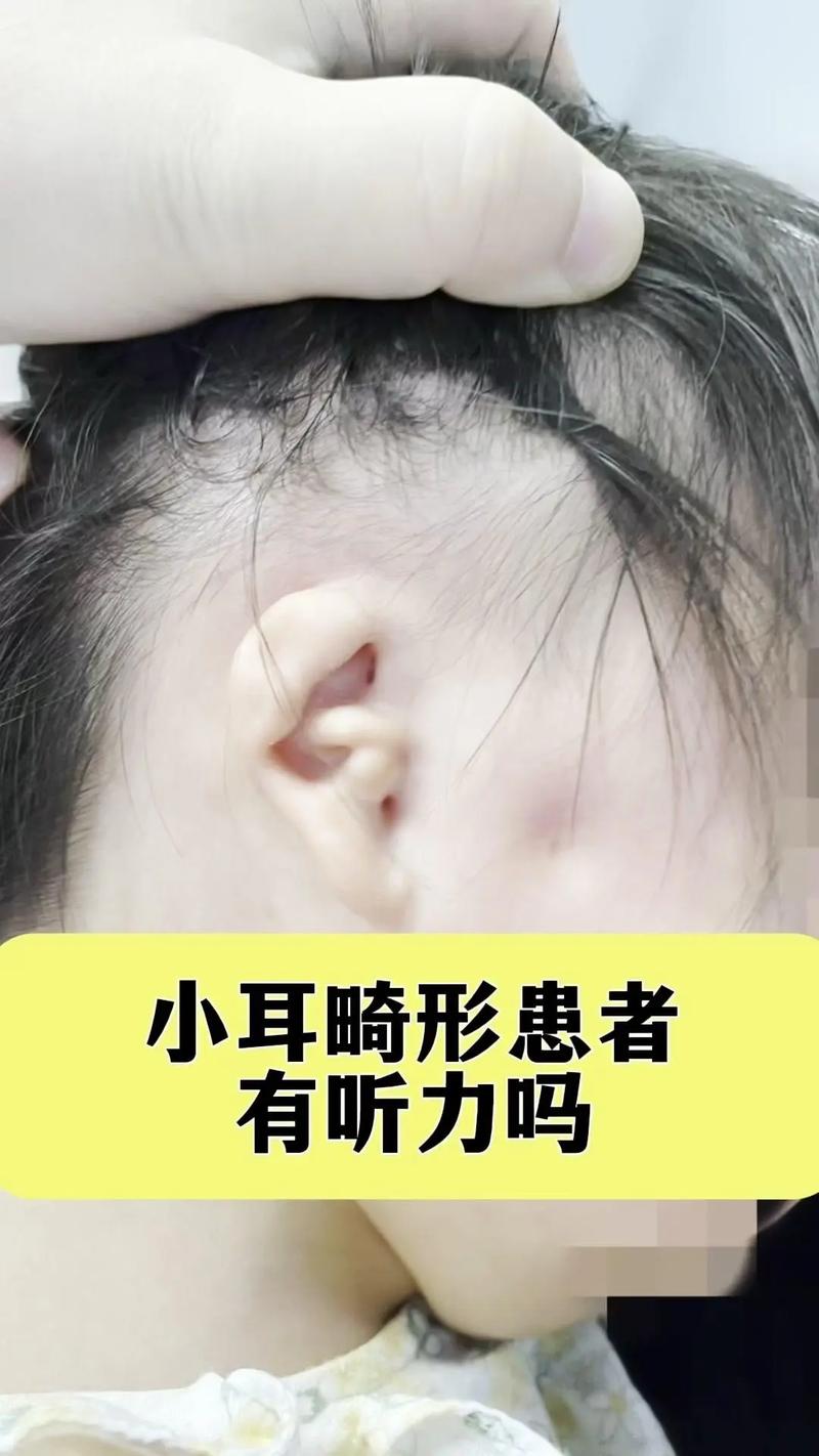 新生儿耳朵黑毛是异常吗？-第2张图片-中州医学会