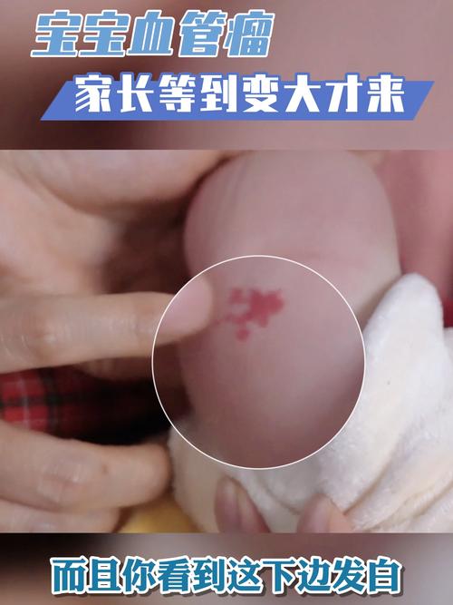 新生儿怎么判断是不是血管瘤-第1张图片-中州医学会