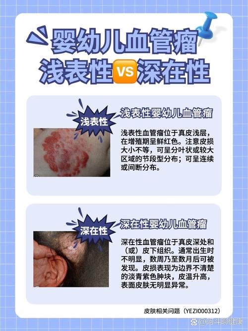 新生儿怎么判断是不是血管瘤-第2张图片-中州医学会