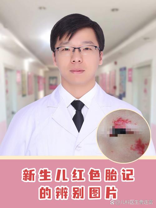 新生儿怎么判断是不是血管瘤-第3张图片-中州医学会