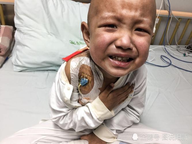 儿童急性白血病早期症状有哪些？-第3张图片-中州医学会