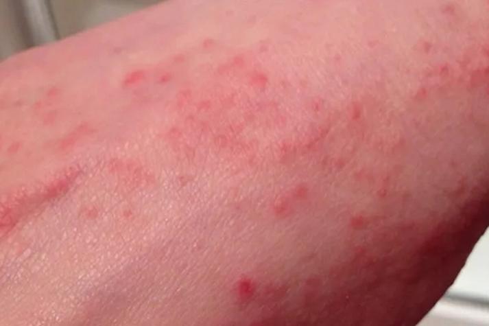 儿童急性白血病早期症状有哪些？-第2张图片-中州医学会