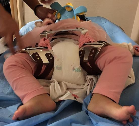 儿童髋关节发育不良有哪些典型症状？-第1张图片-中州医学会