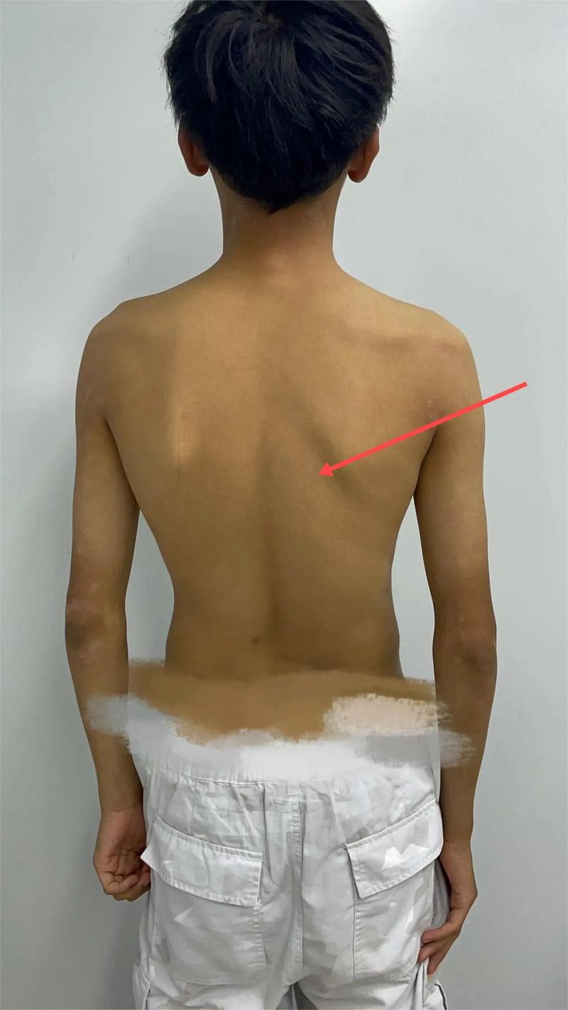 儿童髋关节发育不良有哪些典型症状？-第3张图片-中州医学会