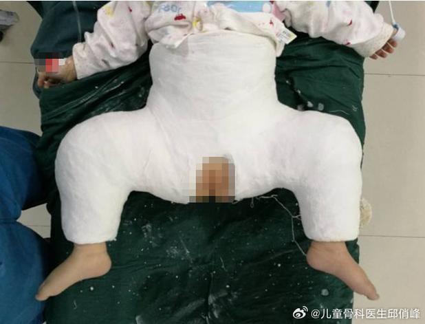 儿童髋关节发育不良有哪些典型症状？-第2张图片-中州医学会