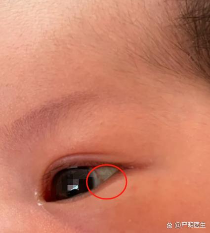 新生儿眼底血管几周能发育好？-第2张图片-中州医学会