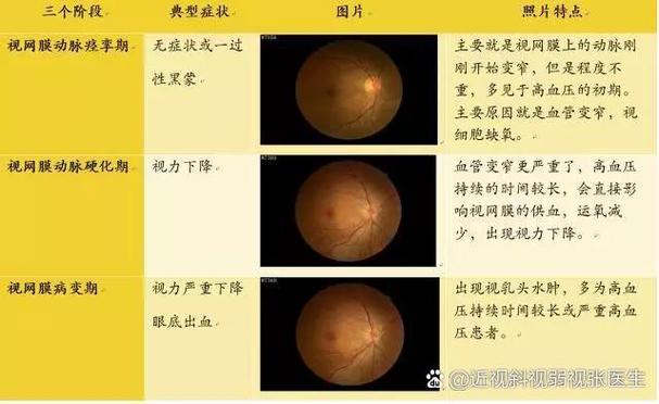 新生儿眼底血管几周能发育好？-第1张图片-中州医学会