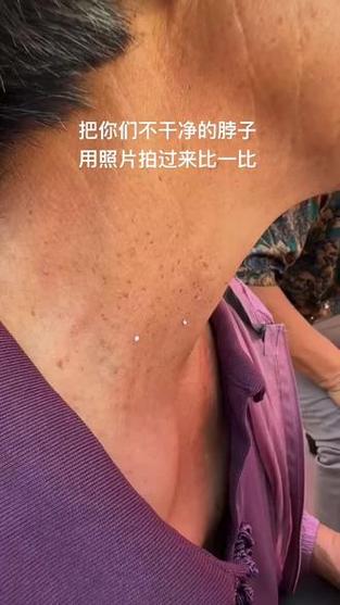 孕期脖上小肉粒是何原因？-第1张图片-中州医学会