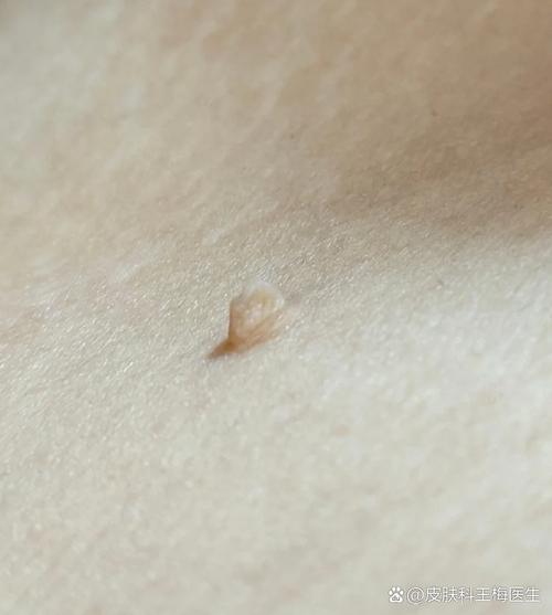 孕期脖上小肉粒是何原因？-第2张图片-中州医学会