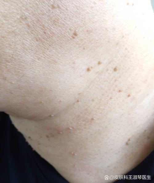 孕期脖上小肉粒是何原因？-第3张图片-中州医学会