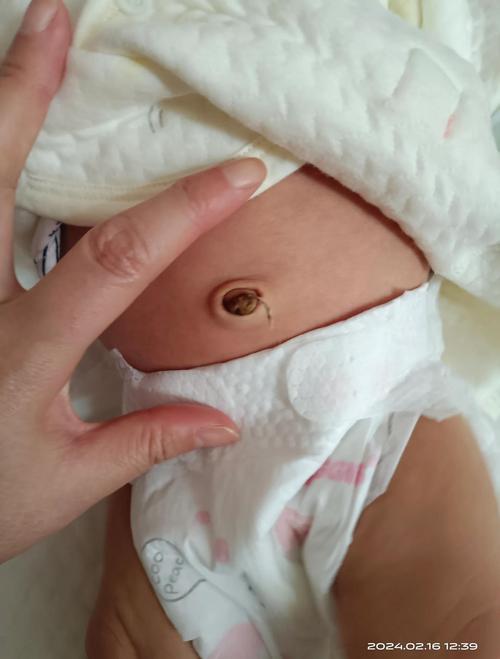 新生儿肚脐内白色物质是何物?-第1张图片-中州医学会 新生儿肚脐内白色物质是何物?-第1张图片-中州医学会