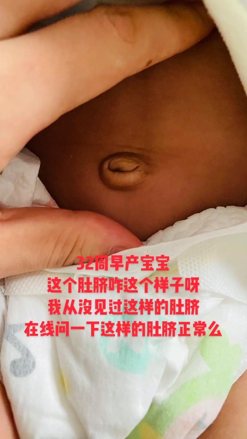 新生儿肚脐内白色物质是何物?-第3张图片-中州医学会 新生儿肚脐内白色物质是何物?-第3张图片-中州医学会