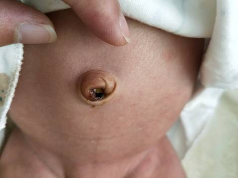 新生儿肚脐内白色物质是何物?-第2张图片-中州医学会 新生儿肚脐内白色物质是何物?-第2张图片-中州医学会