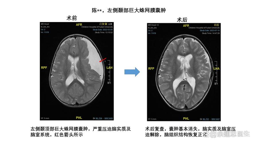 儿童蛛网膜囊肿症状有哪些？-第3张图片-中州医学会