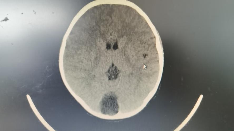 儿童蛛网膜囊肿症状有哪些？-第1张图片-中州医学会
