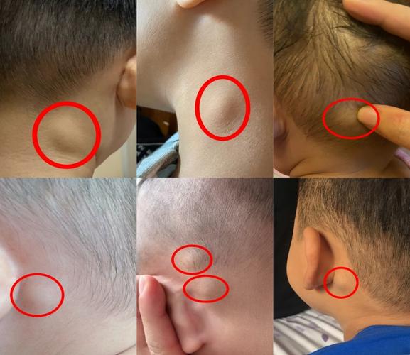 儿童蛛网膜囊肿症状有哪些？-第2张图片-中州医学会