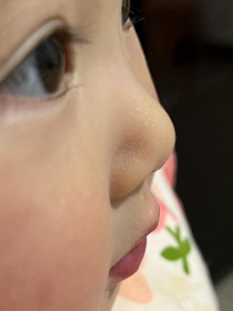 新生儿鼻子白点点是啥？-第1张图片-中州医学会