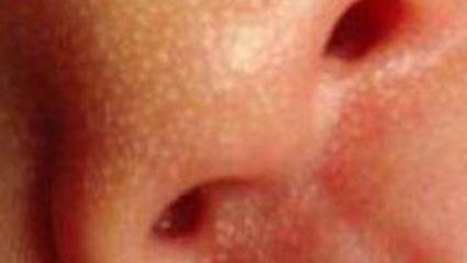 新生儿鼻子白点点是啥？-第2张图片-中州医学会