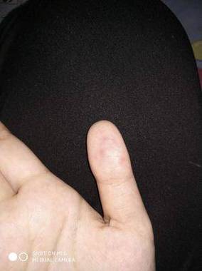 新生儿肚脐里的黑色是啥？-第2张图片-中州医学会