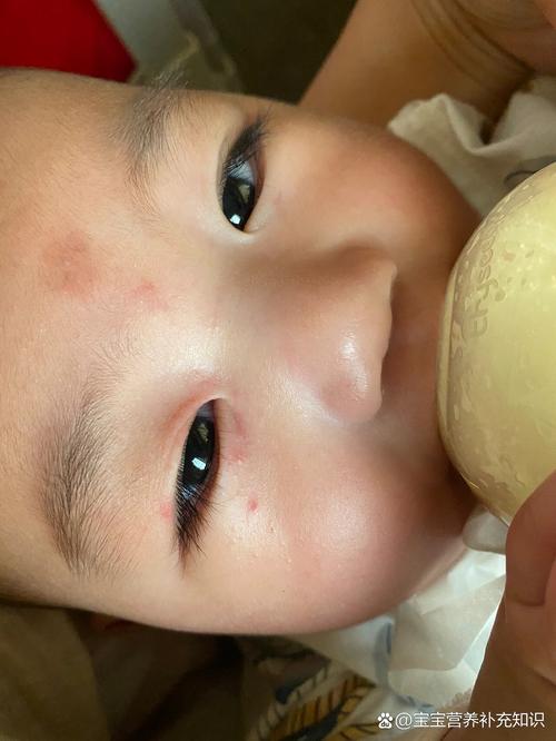 新生儿眼周小米粒疙瘩是啥？要紧吗？-第2张图片-中州医学会