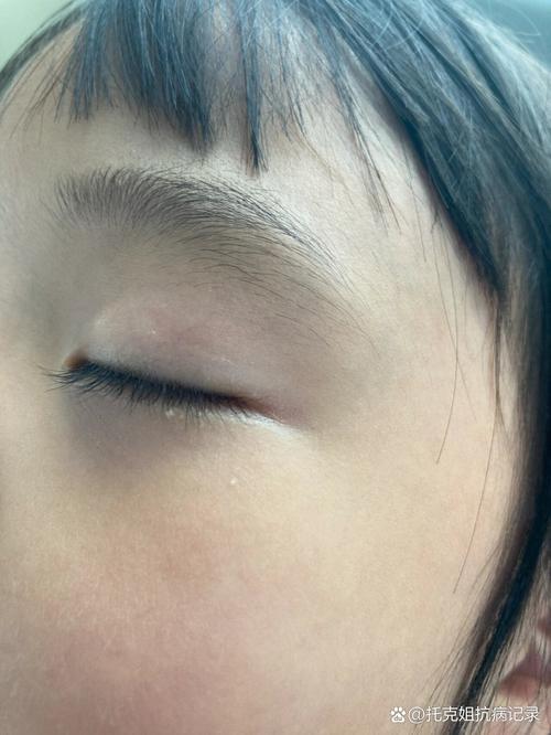 新生儿眼周小米粒疙瘩是啥？要紧吗？-第3张图片-中州医学会