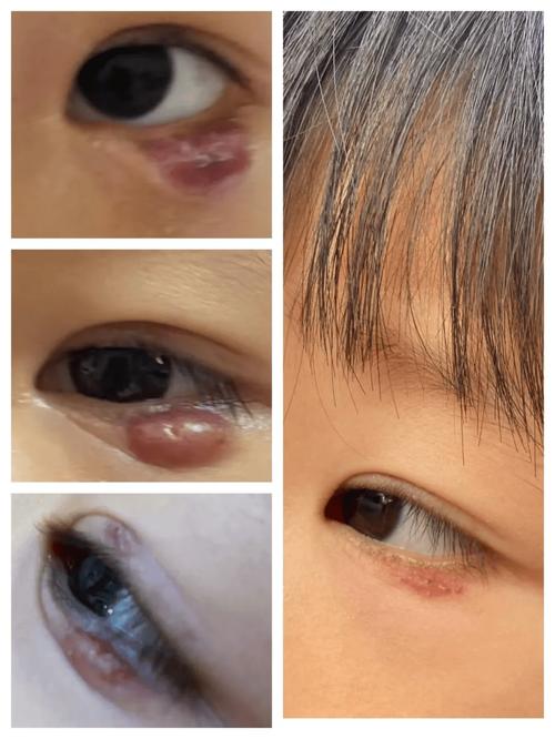 新生儿眼周小米粒疙瘩是啥？要紧吗？-第1张图片-中州医学会